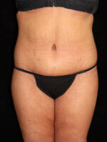 Tummy Tuck - Case 15505 - After