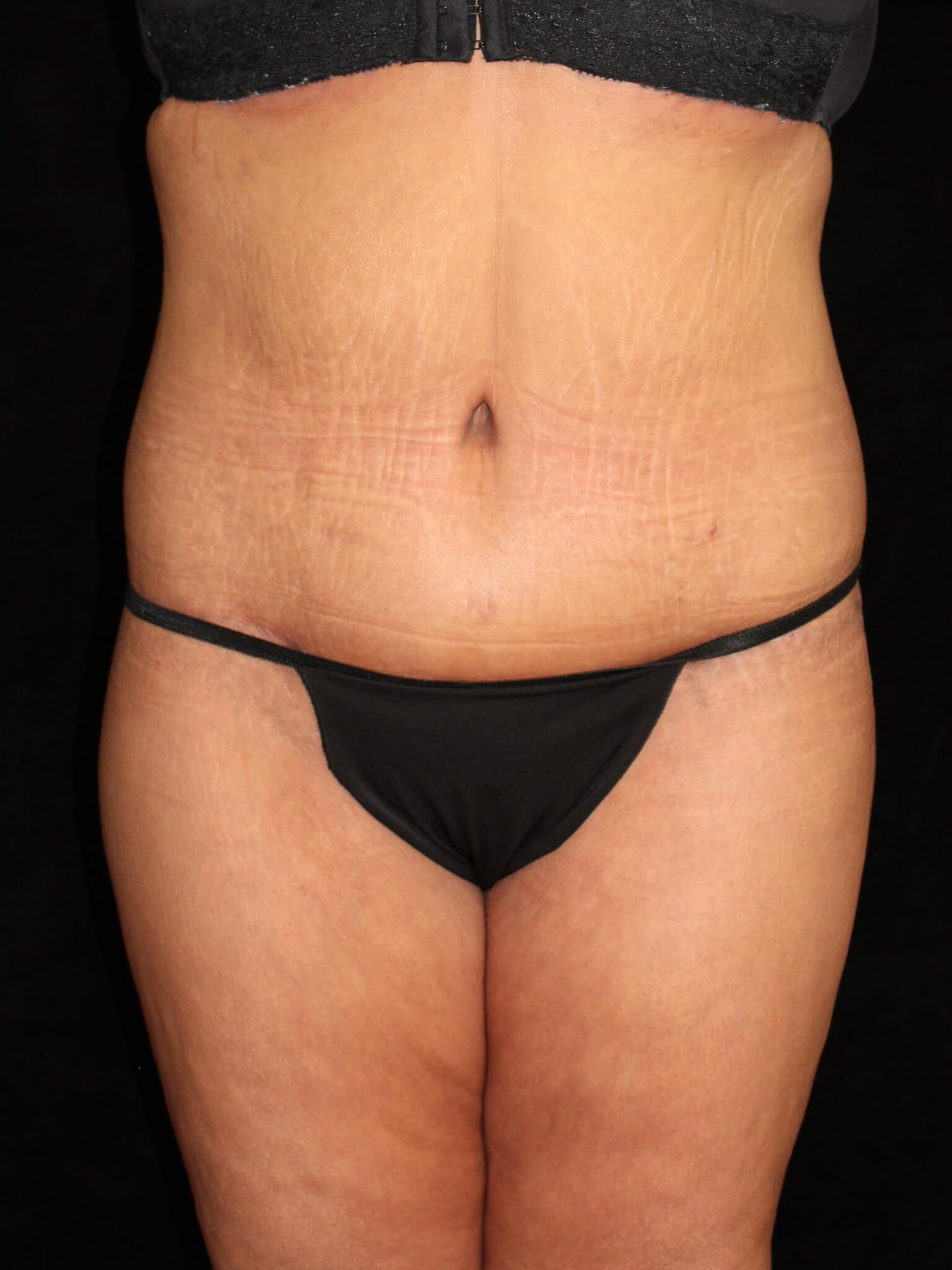 Tummy Tuck Patient Photo - Case 15505 - after view
