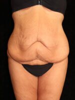Tummy Tuck - Case 15505 - Before
