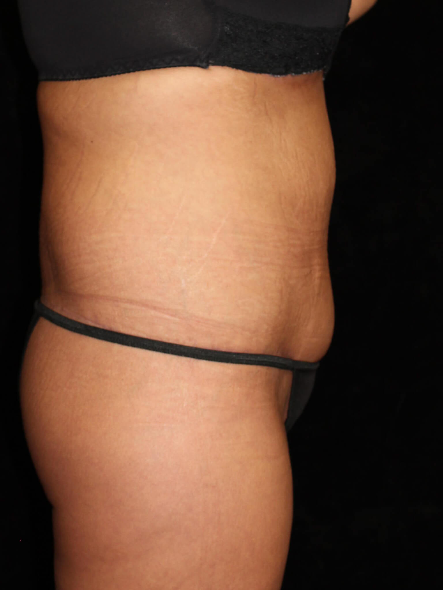Tummy Tuck Patient Photo - Case 15505 - after view-2
