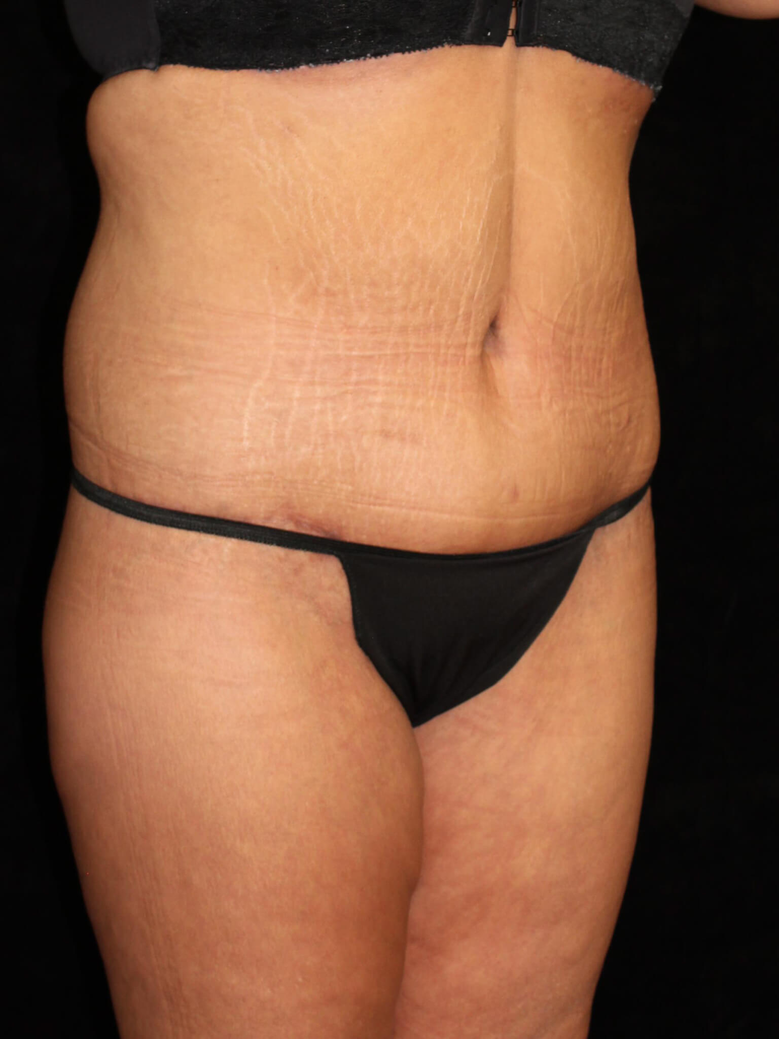 Tummy Tuck Patient Photo - Case 15505 - after view-1