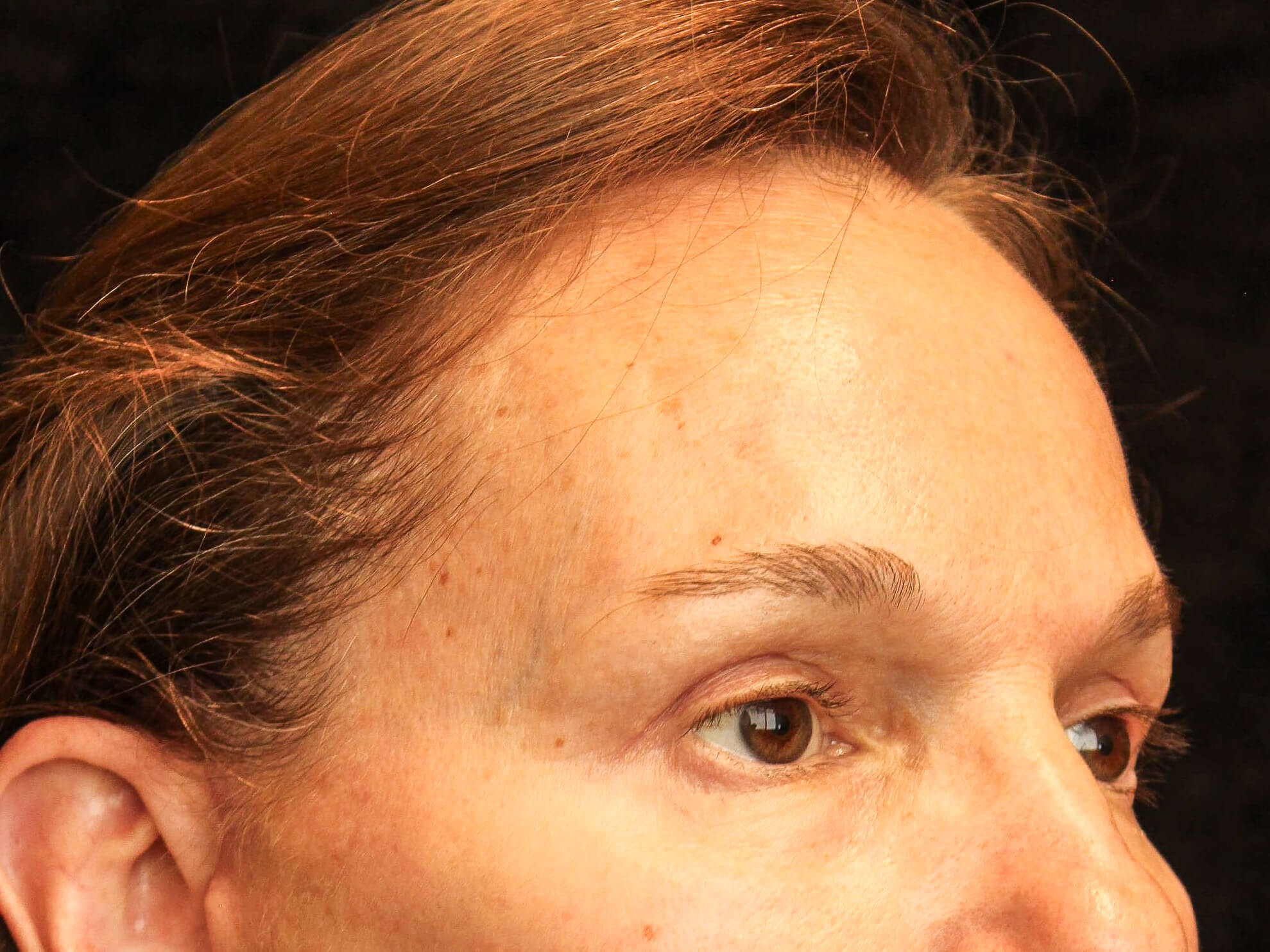 Eyelid Surgery Patient Photo - Case 15902 - after view-1