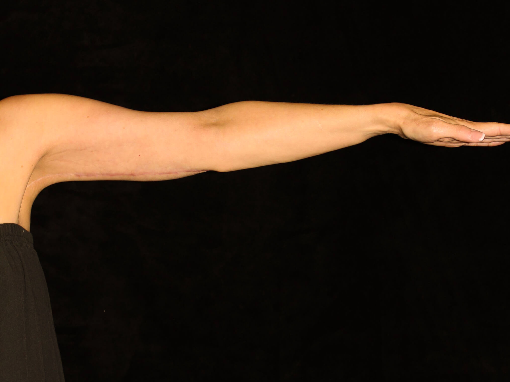 Arm Lift Patient Photo - Case 12997 - after view