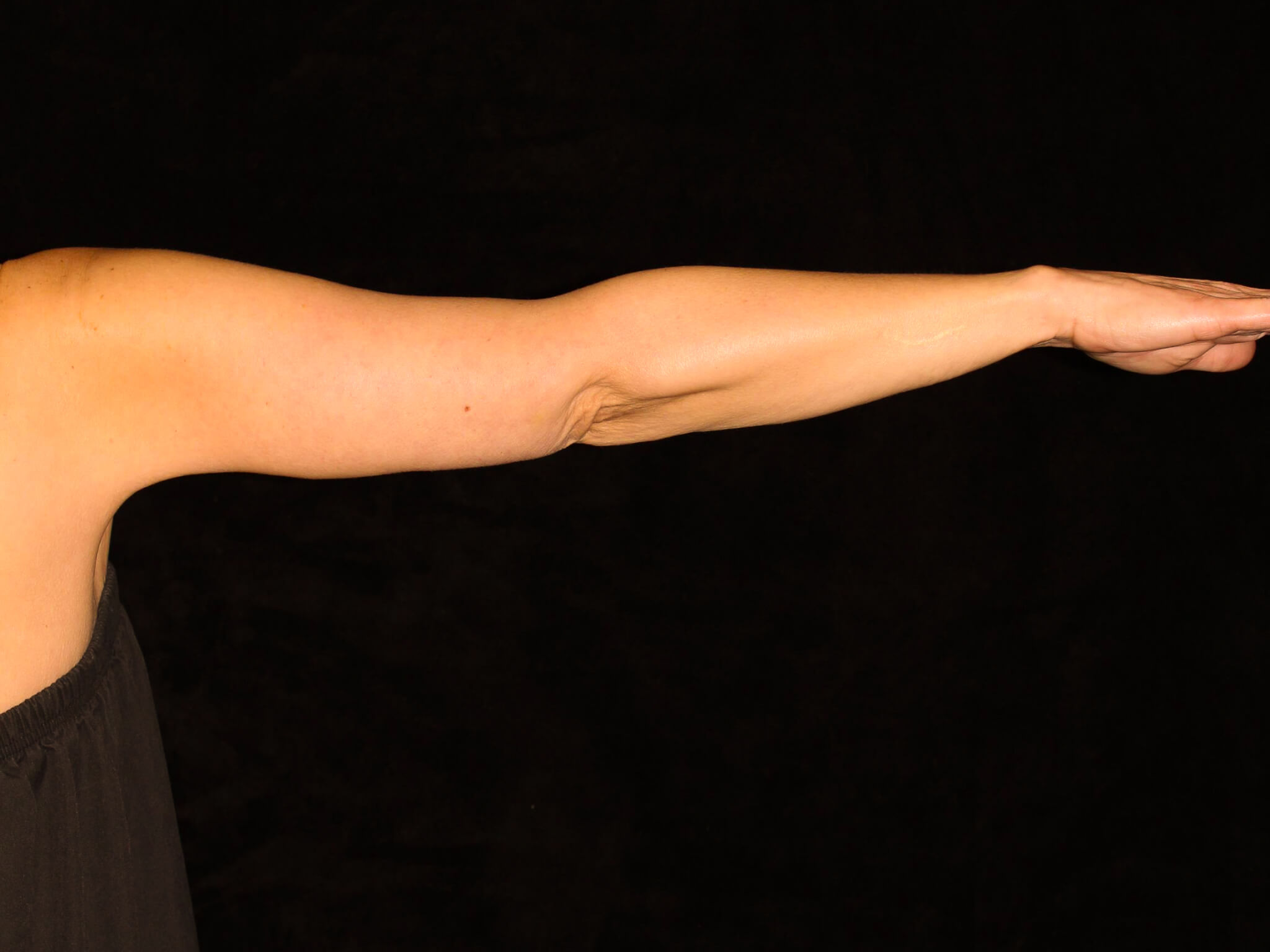 Arm Lift Patient Photo - Case 12997 - after view-1