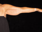Arm Lift before and after results - Nashville patient - Before