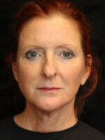 Facelift - Case 15601 - After