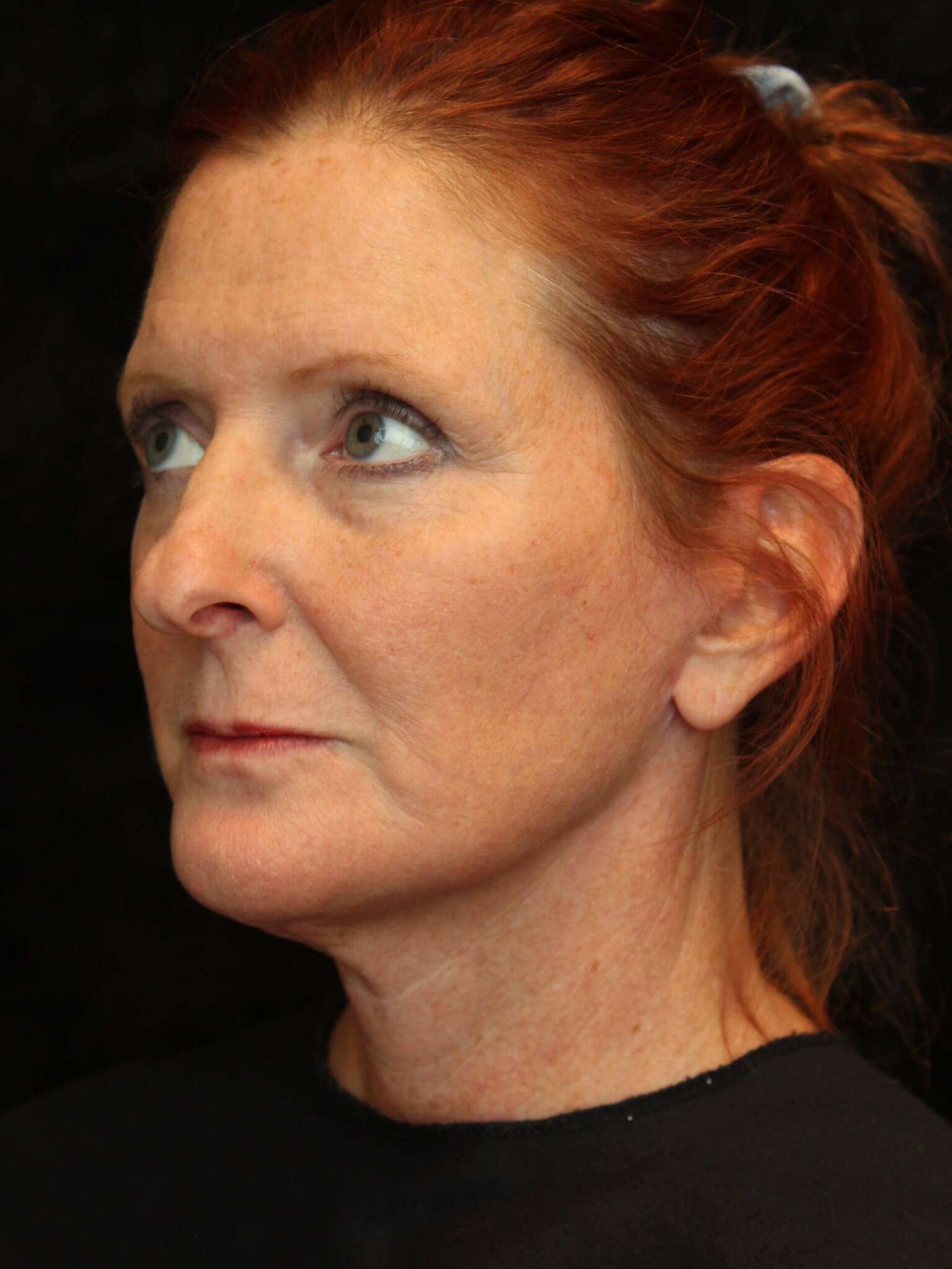 Facelift before and after results - Nashville patient - after view 2