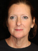 Facelift - Case 15601 - Before