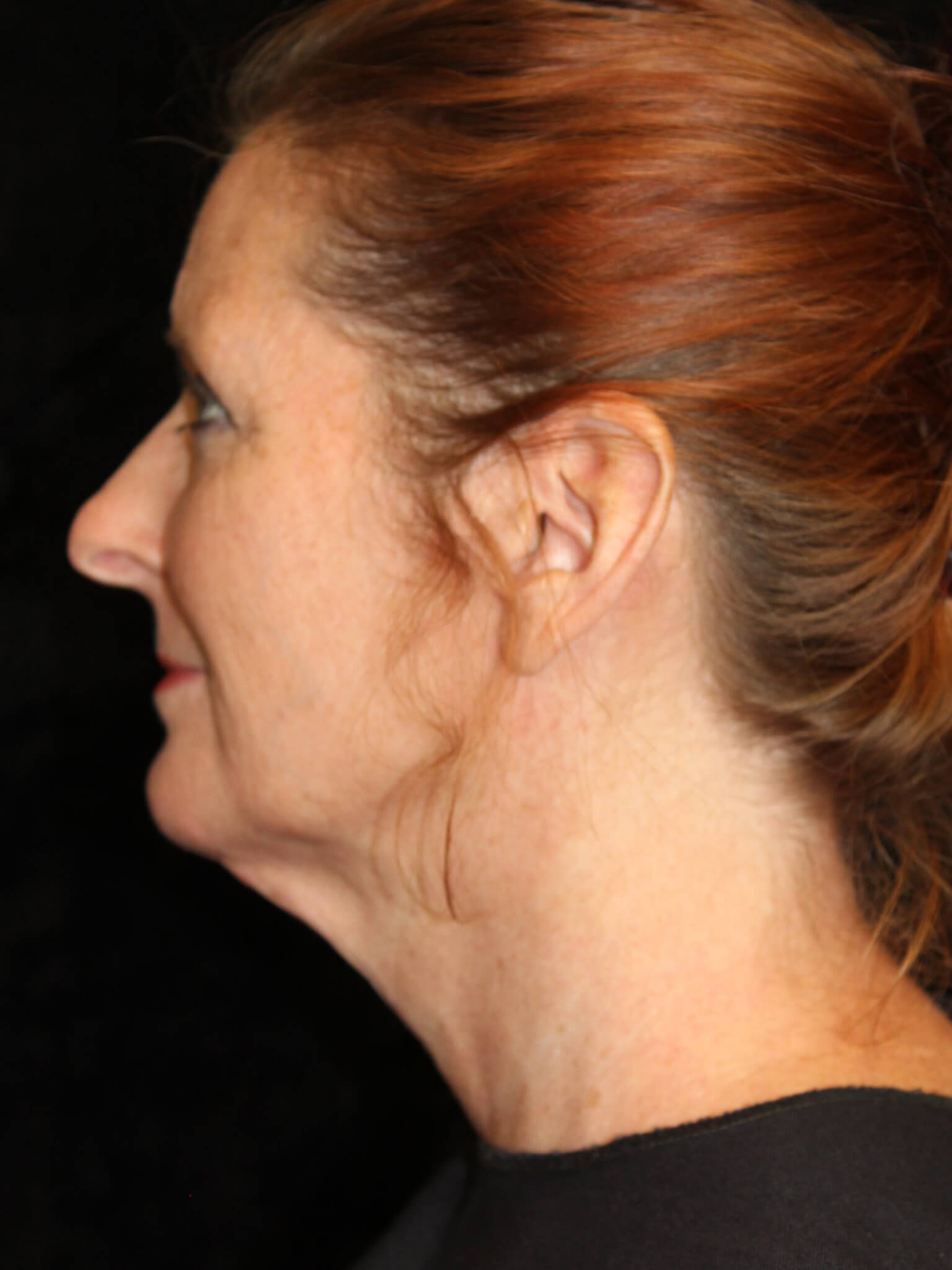 Facelift before and after results - Nashville patient - before view 3