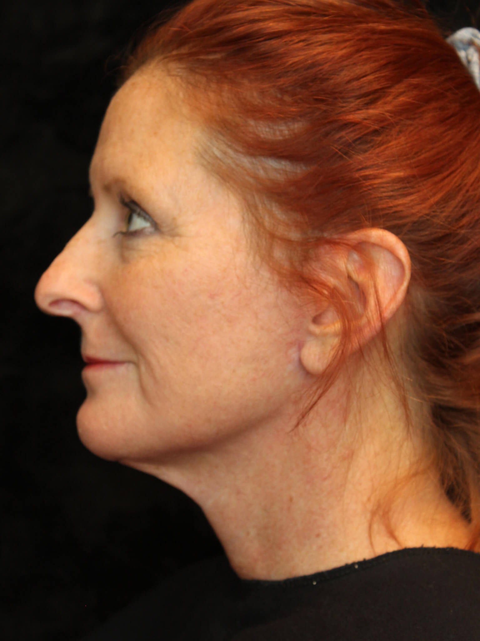 Facelift before and after results - Nashville patient - after view 3