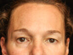Eyelid Surgery - Case 15902 - Before