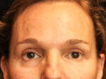 Eyelid Surgery - Case 15902 - After