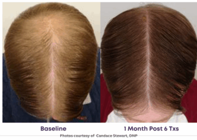 Alma TED Hair Restoration Before and After Hairline 2