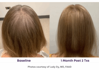 Alma TED Hair Restoration Before and After Thinning Hair on Female