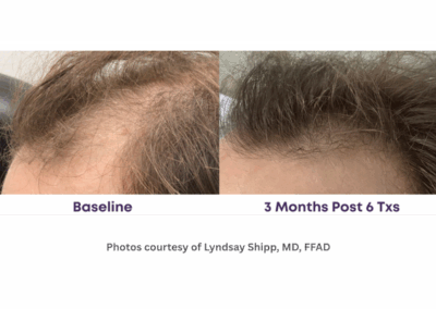 Alma TED Hair Restoration Before and After Mens Temporal Region