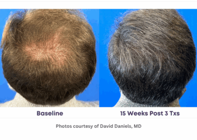 Alma TED Hair Restoration Before and After Crown on Male