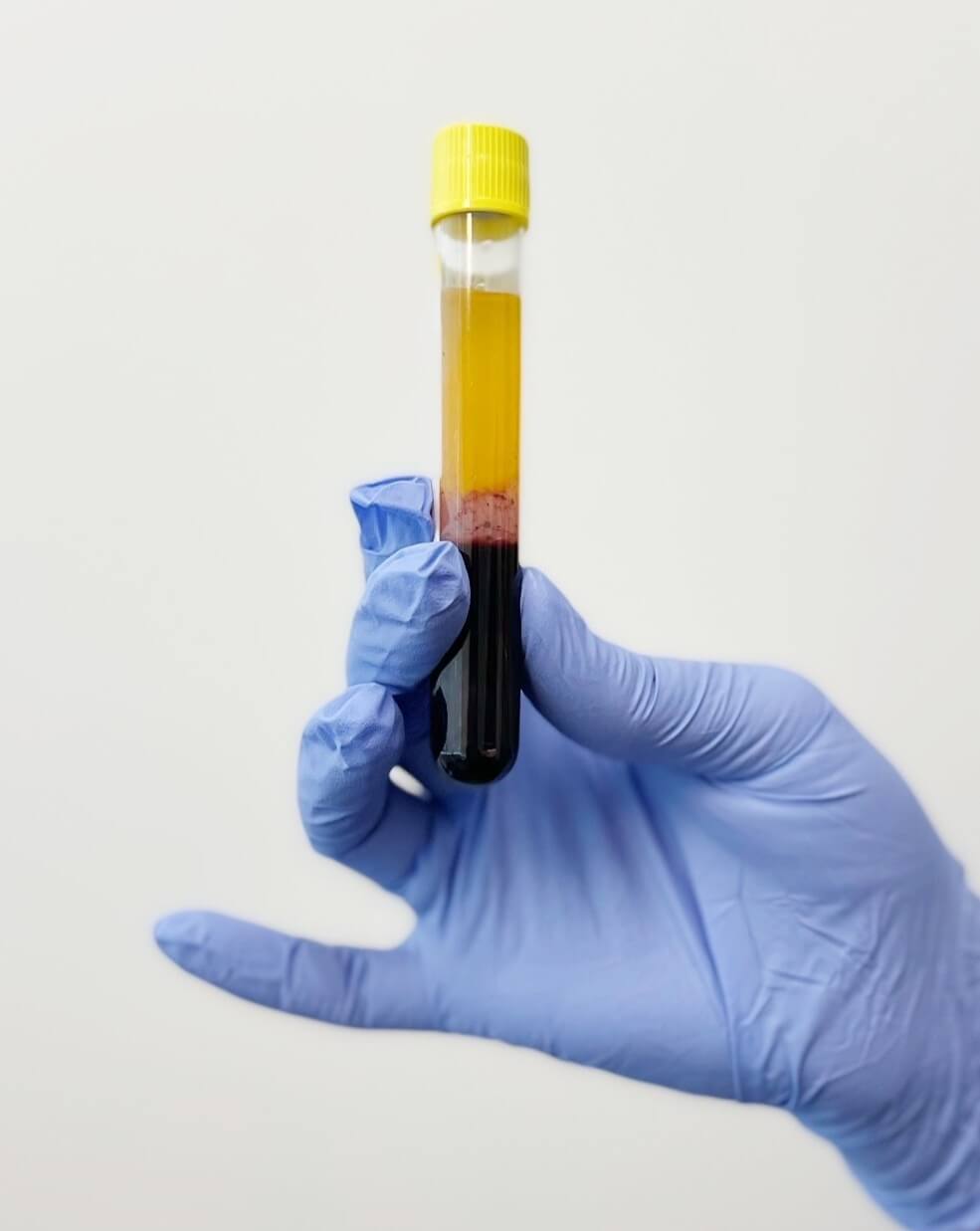 PRP Blood Vial