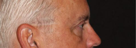 Eyelid Surgery before and after results - Nashville patient - after view 3