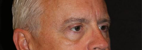 Eyelid Surgery before and after results - Nashville patient - after view 2