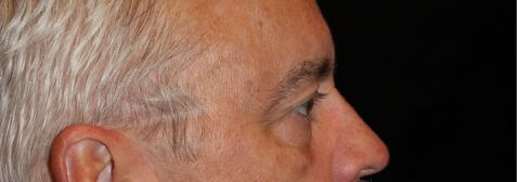 Eyelid Surgery before and after results - Nashville patient - before view 3