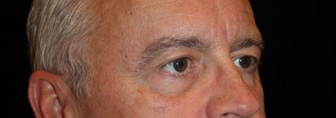 Eyelid Surgery before and after results - Nashville patient - before view 2