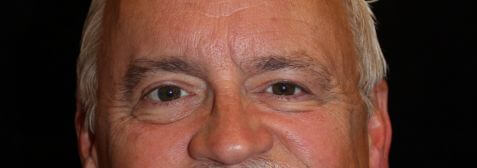 Eyelid Surgery before and after results - Nashville patient - before