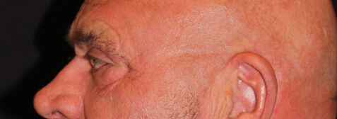 Eyelid Surgery before and after results - Nashville patient - after view 3