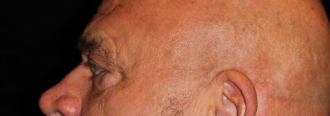 Eyelid Surgery before and after results - Nashville patient - before view 3