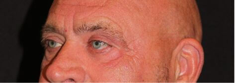Eyelid Surgery before and after results - Nashville patient - after view 2