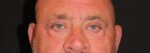 Eyelid Surgery before and after results - Nashville patient - After