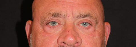 Eyelid Surgery before and after results - Nashville patient - after