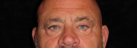 Eyelid Surgery before and after results - Nashville patient - before