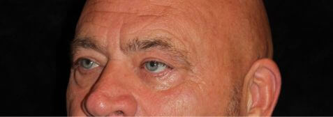 Eyelid Surgery before and after results - Nashville patient - before view 2